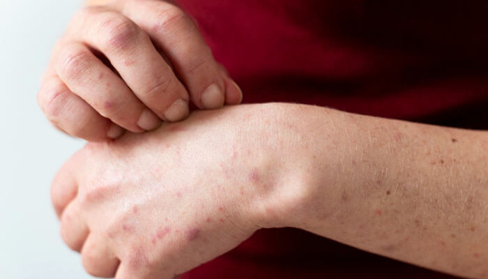 Person scratching red itchy rash on hand, possibly an allergic reaction linked to food sensitivities, raising the question — are eggs dairy or not?
